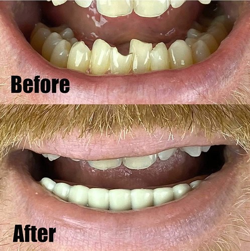 Bottom teeth flexible - flexible, lower